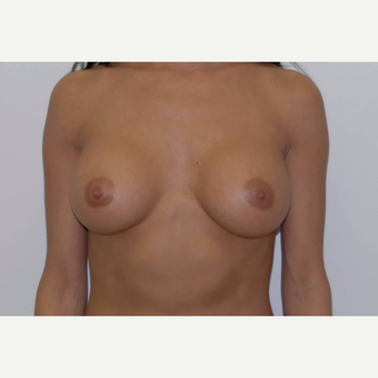 35-44 year old woman treated with Breast Augmentation after 3377471