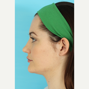 25-34 year old woman treated with Rhinoplasty before 3691104