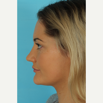 25-34 year old woman treated with Rhinoplasty after 3691104