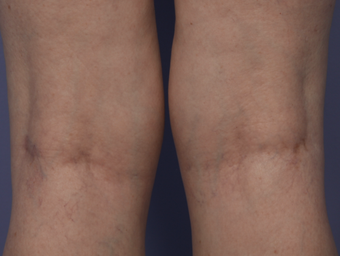 Laser Vein after 302227