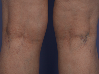 Laser Vein before 302227