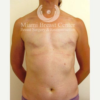 45-54 year old woman with Breast Reconstruction and fat transfer before 2217037