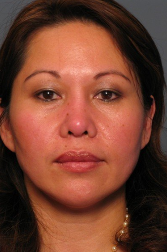 Nose Surgery after 338486