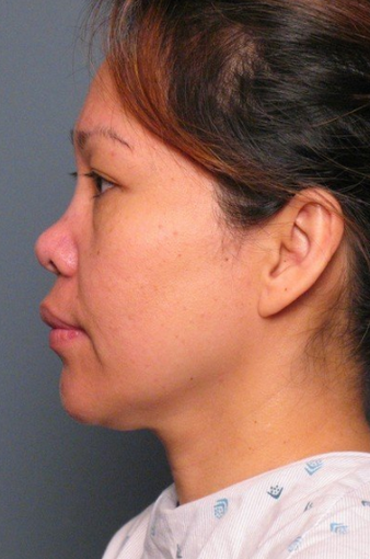 Nose Surgery 338486