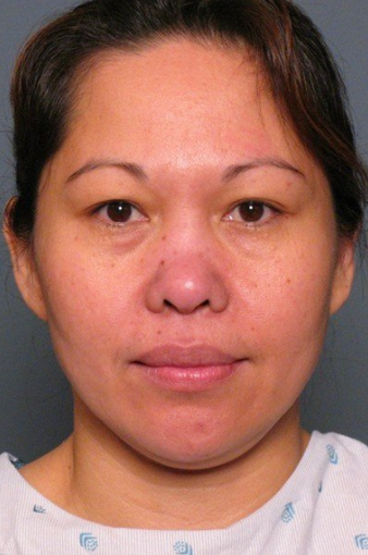 Nose Surgery before 338486