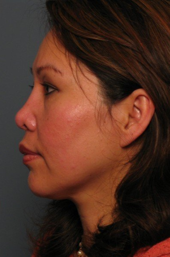 Nose Surgery 338486