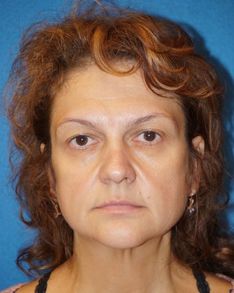 49 year old man treated with Facelift 3576611