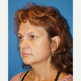 49 year old man treated with Facelift before 3576611