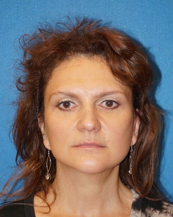 49 year old man treated with Facelift 3576611