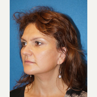 49 year old man treated with Facelift after 3576611
