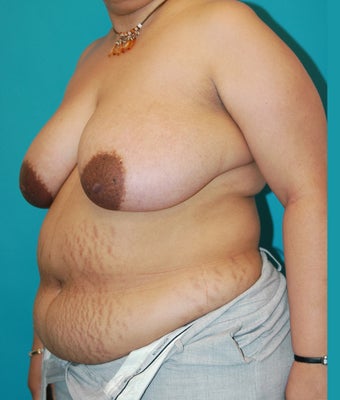 25-34 year old woman treated with Mommy Makeover 1672499