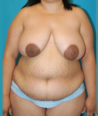 25-34 year old woman treated with Mommy Makeover before 1672499