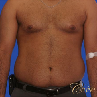 23 year old with moderate gynecomastia before 3196747
