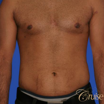 23 year old with moderate gynecomastia after 3196747