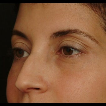45-54 year old woman treated for Eyelid Surgery before 1479653