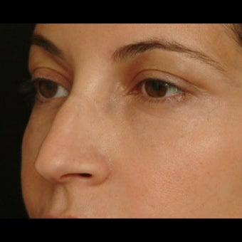 45-54 year old woman treated for Eyelid Surgery after 1479653