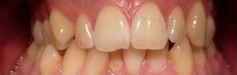 Fixed metal braces before 3135214