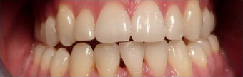 Fixed metal braces after 3135214
