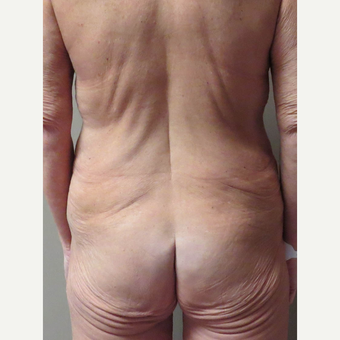 Body Lift for this 48 Year Old Woman before 3042857