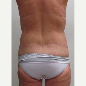 Body Lift for this 48 Year Old Woman after 3042857