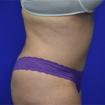 35-44 year old woman treated with Tummy Tuck after 3325794