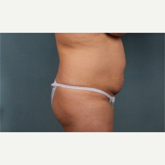 35-44 year old woman treated with Tummy Tuck before 3325794