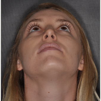18-24 year old woman treated with Septoplasty 1 year post-op after 3499825