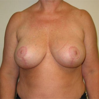 48 year old woman treated with Breast Implant Removal and Breast lift after 2285397