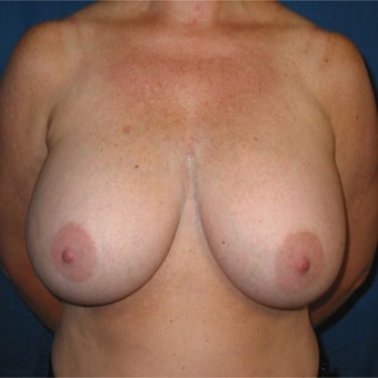 48 year old woman treated with Breast Implant Removal and Breast lift before 2285397