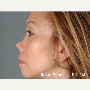 35-44 year old woman treated with Revision Rhinoplasty before 2029637