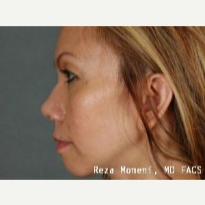 35-44 year old woman treated with Revision Rhinoplasty after 2029637