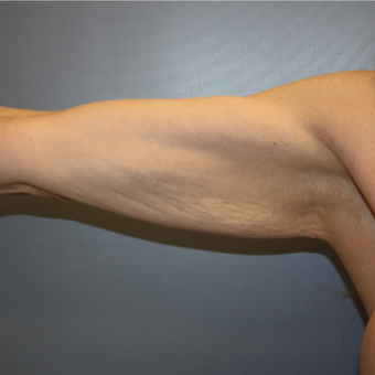 35-44 year old woman treated with Arm Lift before 3808280