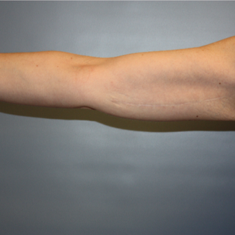 35-44 year old woman treated with Arm Lift after 3808280