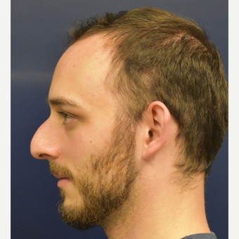 18-24 year old man treated with Septoplasty before 3067141