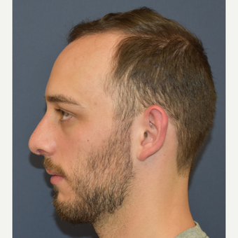 18-24 year old man treated with Septoplasty after 3067141