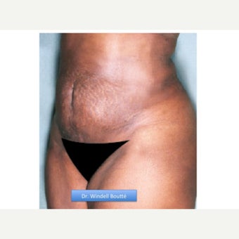 35-44 year old woman treated with Smart Lipo after 1651739