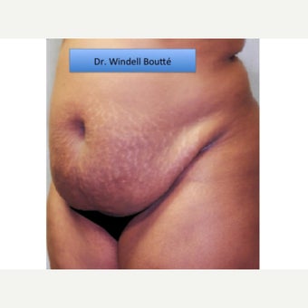 35-44 year old woman treated with Smart Lipo before 1651739