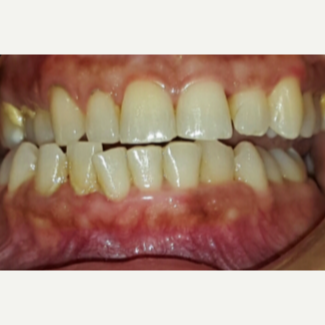 25-34 year old woman treated with Teeth Whitening before 3176914