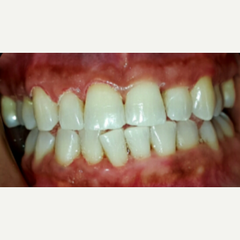25-34 year old woman treated with Teeth Whitening after 3176914
