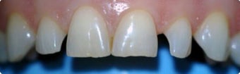 45-54 year old woman treated with Dental Bonding before 3031470