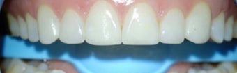 45-54 year old woman treated with Dental Bonding after 3031470