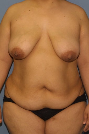 Full Tummy tuck and breast lift-- Mommy Makeover. before 731321