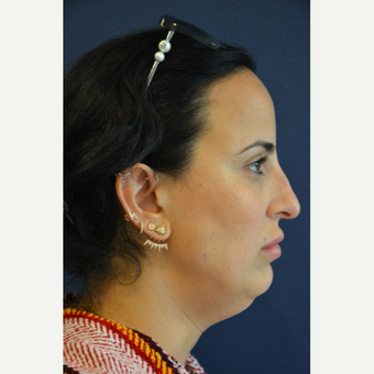 35-44 year old woman treated with Non Surgical Nose Job before 3567024