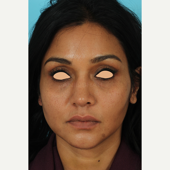 25-34 year old woman treated with Revision Rhinoplasty after 3691230