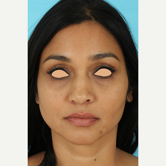 25-34 year old woman treated with Revision Rhinoplasty before 3691230