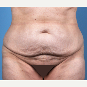 65-74 year old woman treated with Tummy Tuck before 3837510
