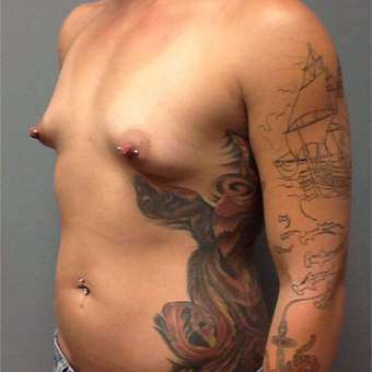 25-34 year old woman treated with Breast Augmentation before 3202312