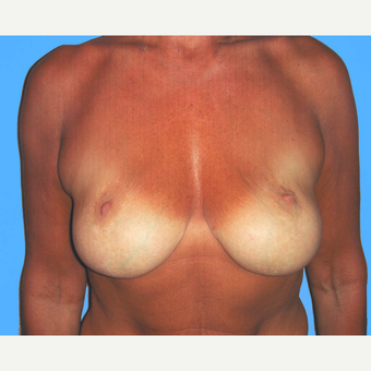 Breast Lift with Implants before 3748842