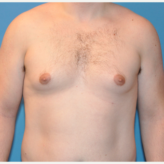 Male Breast Reduction in 26 year old with Gynecomastia before 3705370