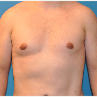 Male Breast Reduction in 26 year old with Gynecomastia after 3705370